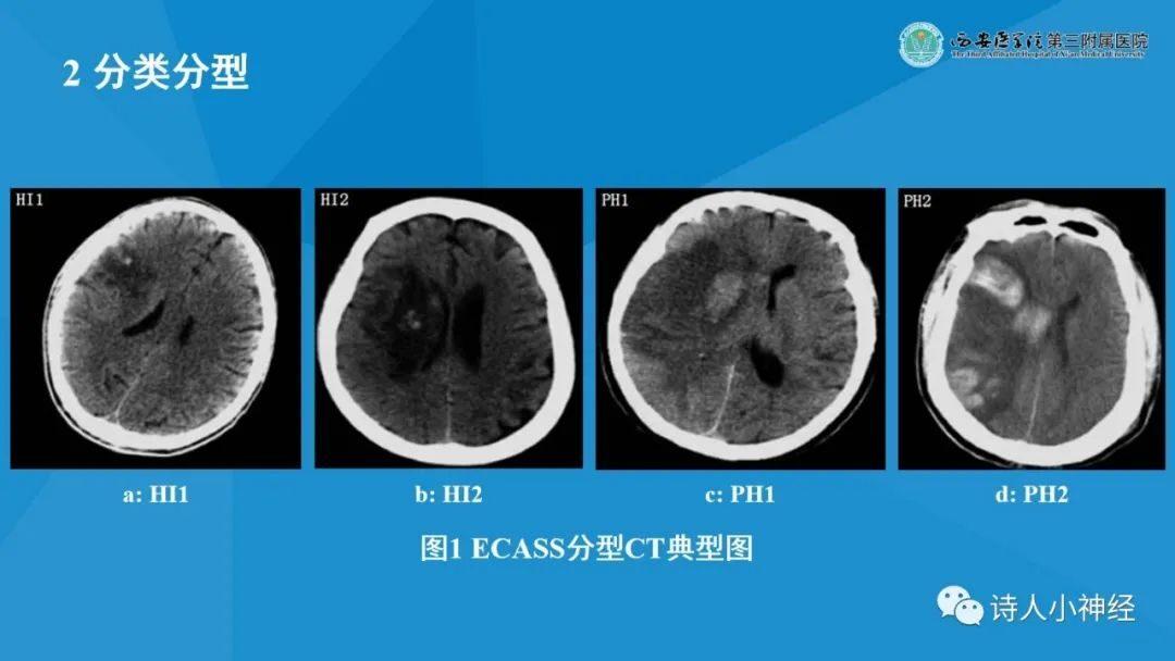 课件学习 | 《急性脑梗死后出血转化诊断与处理》解读