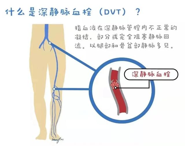 女子骨折后又患深静脉血栓…一查竟是这个原因