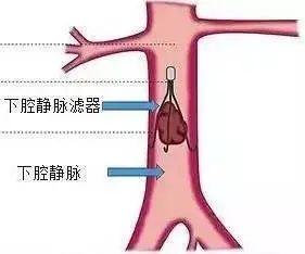 女子骨折后又患深静脉血栓…一查竟是这个原因