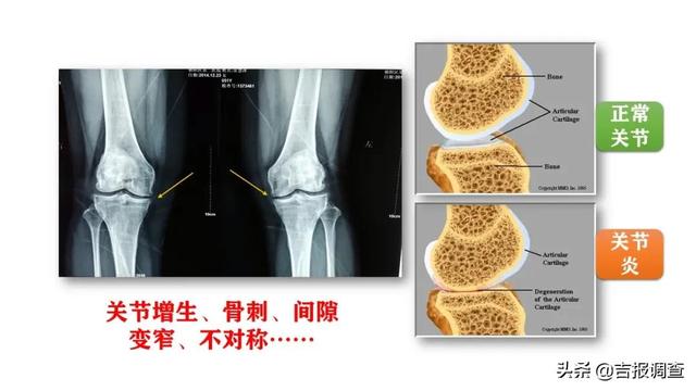 上下楼梯膝盖疼？中医专家警告：当心是膝关节骨性关节炎作祟