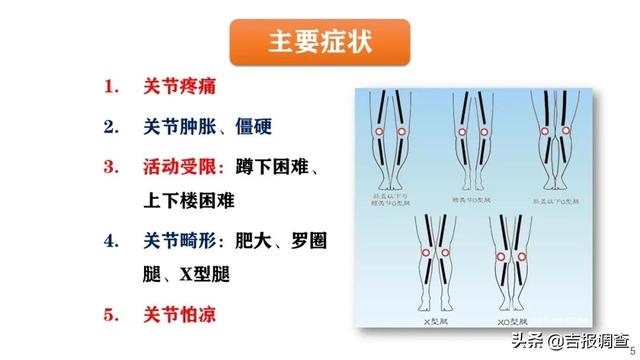 上下楼梯膝盖疼？中医专家警告：当心是膝关节骨性关节炎作祟