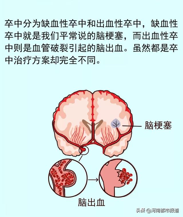 有一种卒中与心脏有关