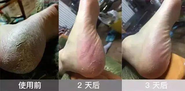 秋冬了，手脚风一吹就像刀子割得一样痛，痛到走不动，看着不心疼吗？