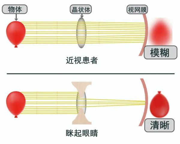 眼睛近视的人为什么眯起眼睛就能看得更清楚一些？