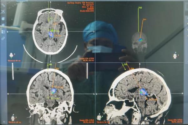 贵州绥阳：首次运用机器人完成神经外科手术