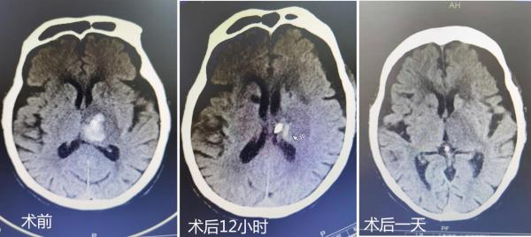 贵州绥阳：首次运用机器人完成神经外科手术