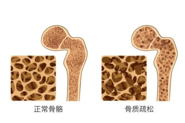 64岁老汉坚持早起1个馒头，不幸离世，医生：吃一口等于5斤鸡精，趁早扔