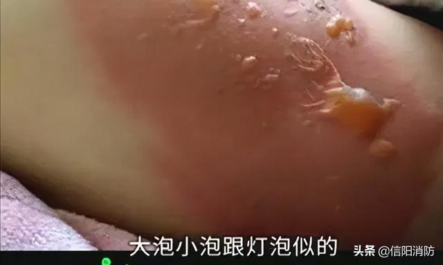 小心暖手宝成为“定时炸弹”