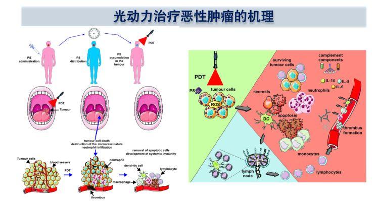 癌症能“见光死”？这项技术让超130位膀胱癌患者看到希望