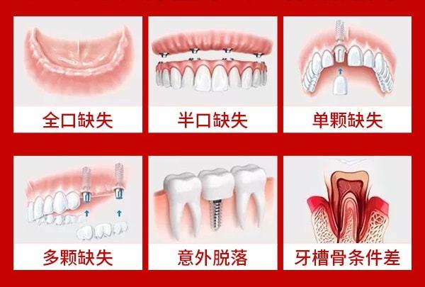 速领！官方看牙补贴！种牙最低补贴5900元，柳州市民9.9元洗牙、补牙、拔牙，发放100份