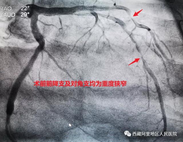 阿里地区人民医院实现介入治疗零突破 填补一项医疗技术空白