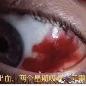 眼睛出血，究竟可不可怕？