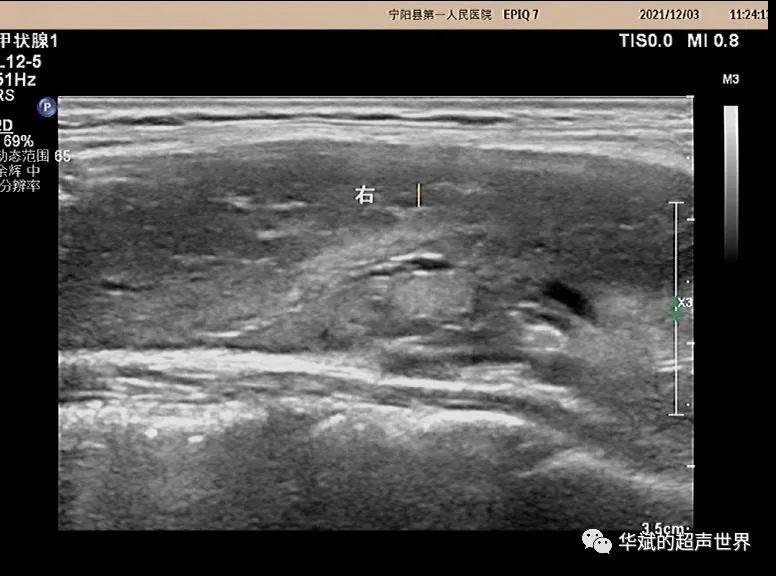 超声问答丨这个颈部淋巴结应该如何考虑？