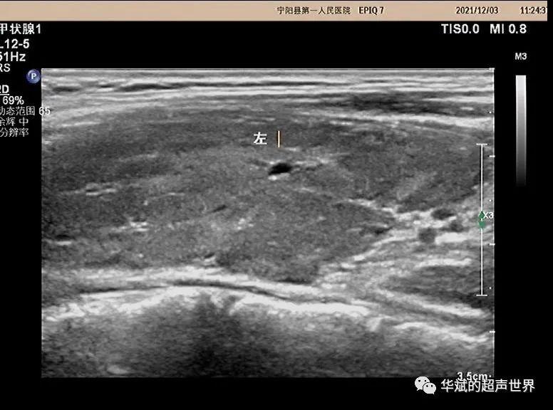 超声问答丨这个颈部淋巴结应该如何考虑？