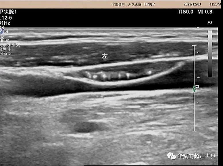超声问答丨这个颈部淋巴结应该如何考虑？