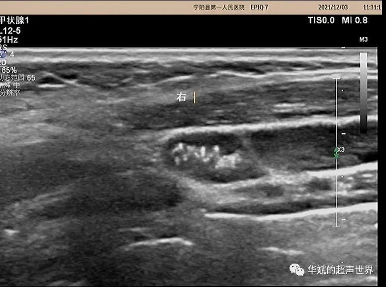 超声问答丨这个颈部淋巴结应该如何考虑？