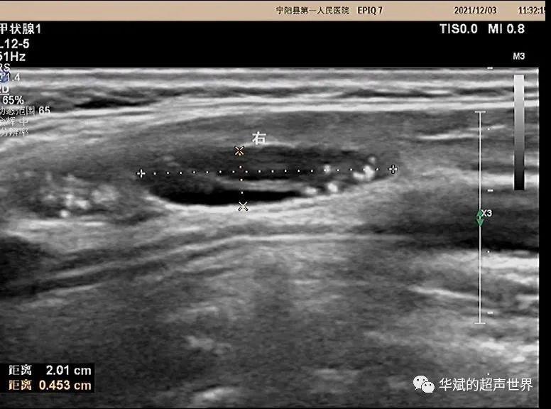 超声问答丨这个颈部淋巴结应该如何考虑？