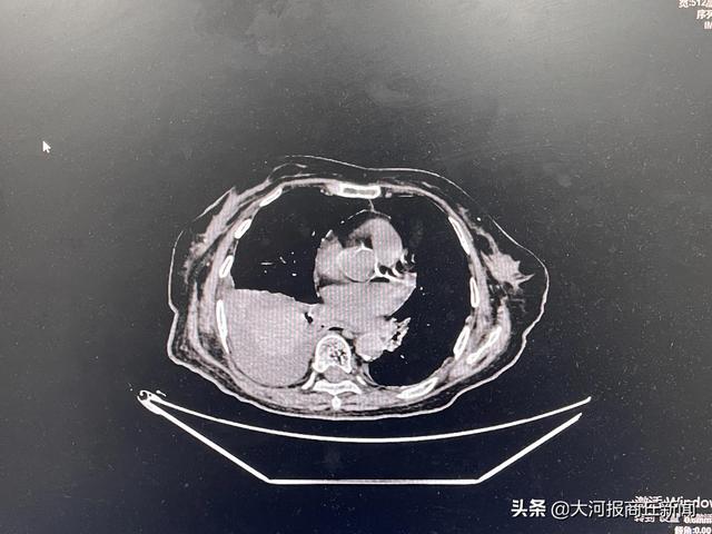 商丘市中医院外一科：医院真情暖人心 家属感恩送锦旗