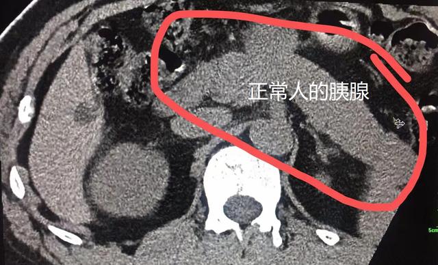 胖婆婆胃痛5年 来院检查发现胰腺不见了