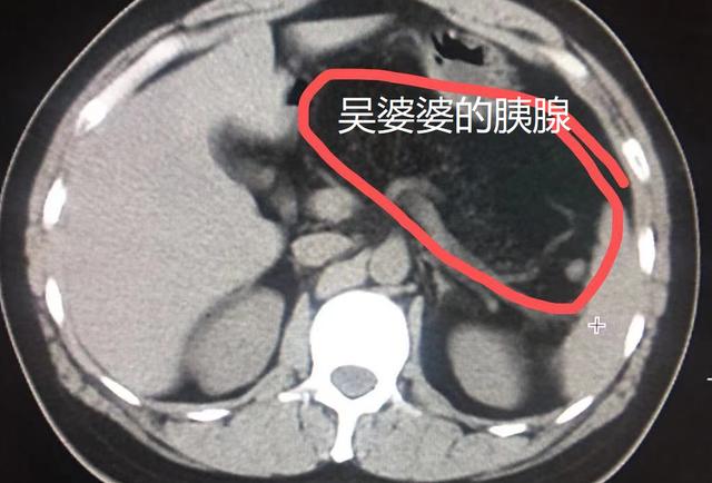 胖婆婆胃痛5年 来院检查发现胰腺不见了