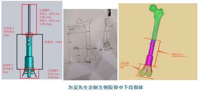 44岁木工查出恶性骨瘤，3D打印为他量身定制股骨假体