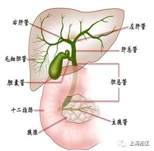 肝外胆管结石是什么，又该如何预防？松江医生来支招→