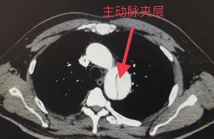 固始妇幼又成功完成一例主动脉夹层覆膜支架腔内隔绝术