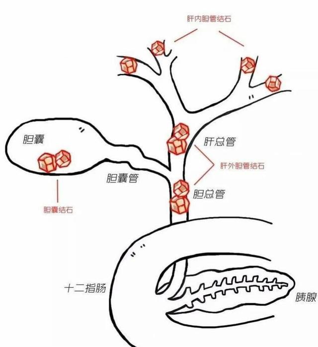 男子腹痛三天变成“小黄人”经内镜下球囊取石解除胆管梗阻