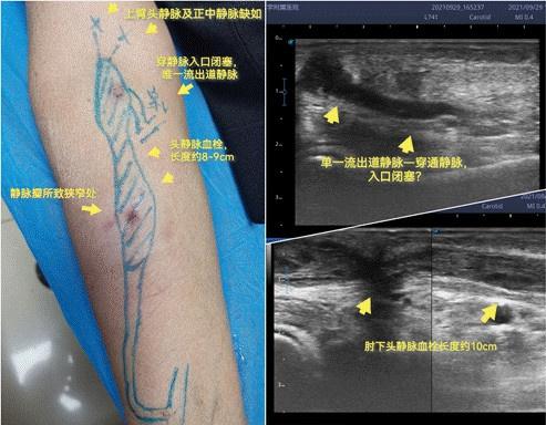 为保正常透析医院为孤寡老人开通失功内瘘