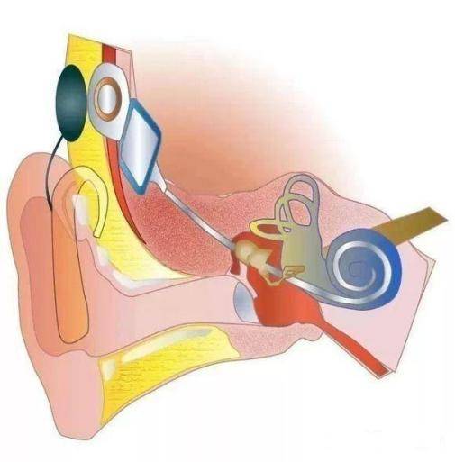 关于人工耳蜗植入，你了解多少？