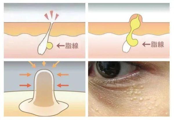 新安生活馆｜长了脂肪粒到底挤不挤？教你处理它的正确姿势