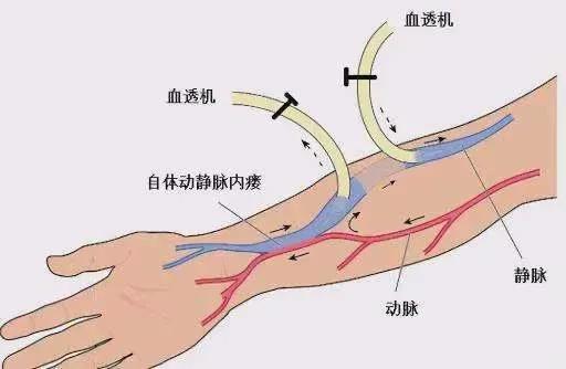 让“内瘘成型”不再难—信阳市中心医院血液净化室开展动静脉内瘘成型日间手术