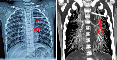 反复咳嗽！1岁女孩胸部扎进钢针，竟全然不知道……