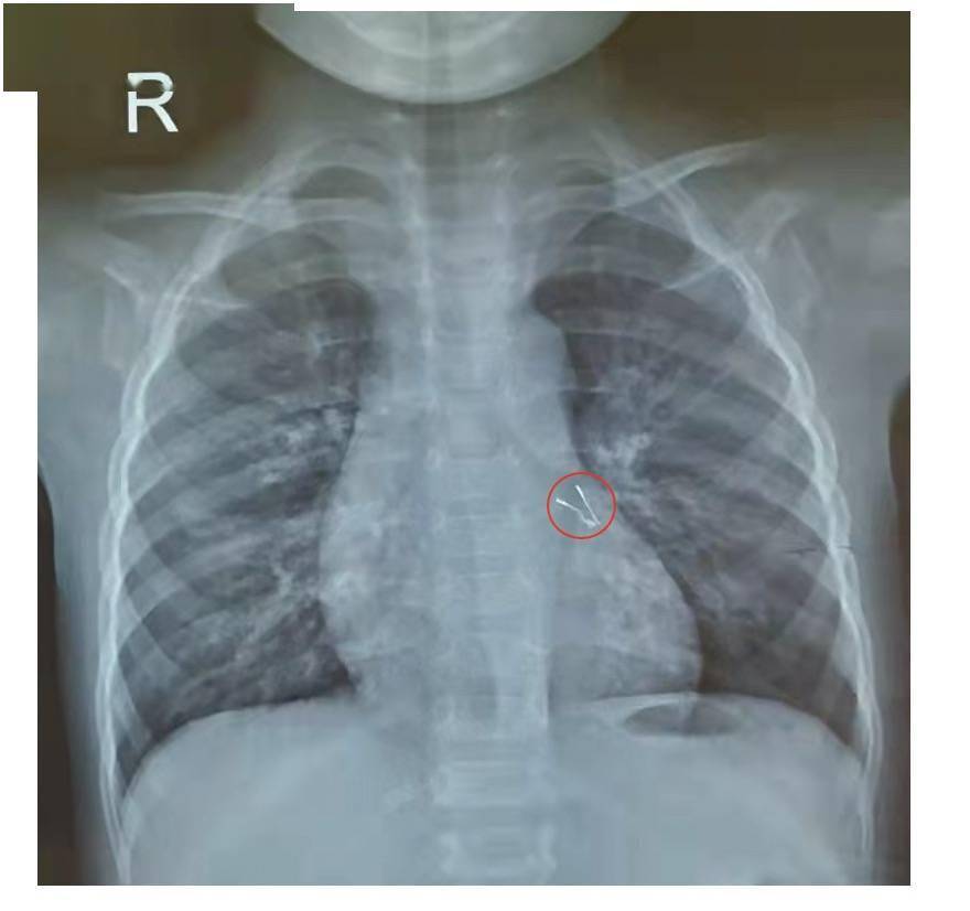 1岁半宝宝咳嗽一周肺里有“长脚”异物，竟是过节用的小灯泡
