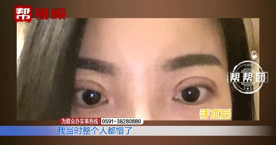 为美割了双眼皮，这半年的经历令女子崩溃