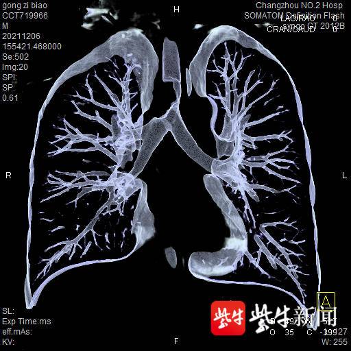 常州二院完成市首例ECMO支持下气管肿瘤切除术