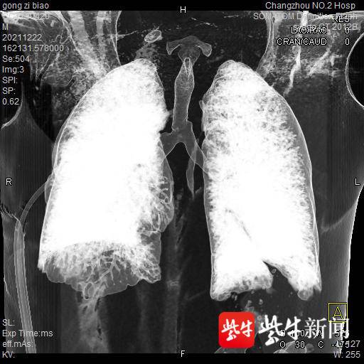 常州二院完成市首例ECMO支持下气管肿瘤切除术