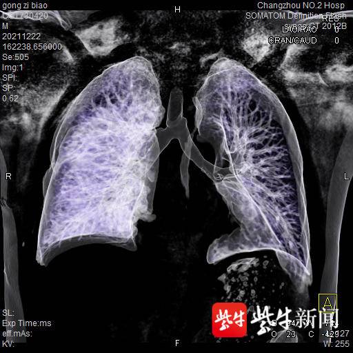 常州二院完成市首例ECMO支持下气管肿瘤切除术