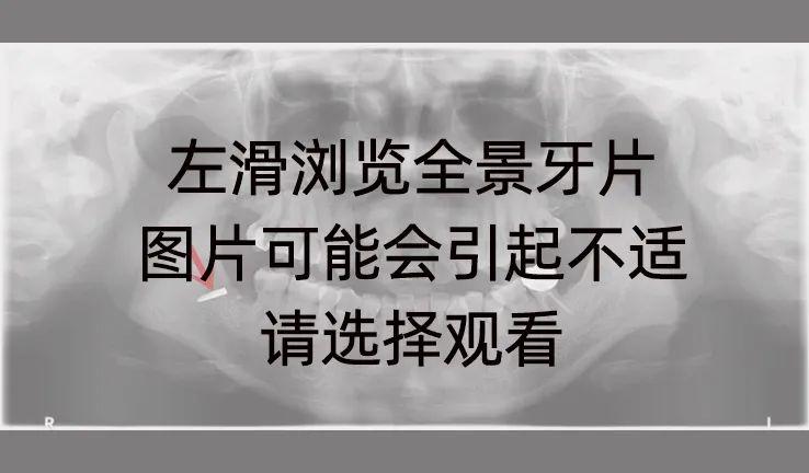 好消息，2022年看牙新补贴发布，速领