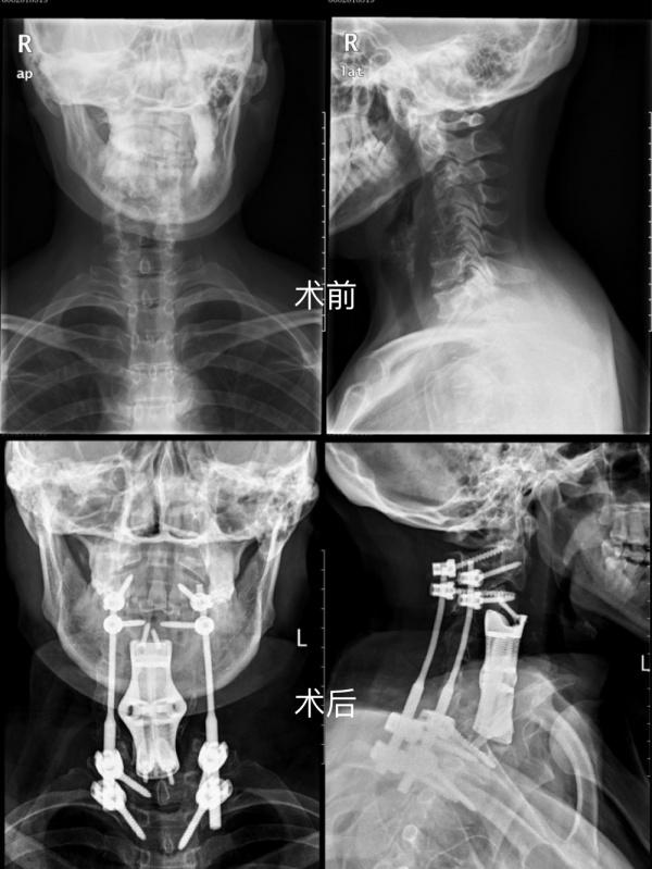 重医二院·聚焦前沿｜第73期 前后入路联合挑战“生命禁区” 3D打印让恶性颈椎肿瘤患者获新生