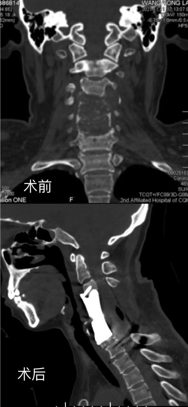 重医二院·聚焦前沿｜第73期 前后入路联合挑战“生命禁区” 3D打印让恶性颈椎肿瘤患者获新生