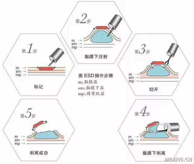 云浮市人民医院：早发现 早治疗 让消化道肿瘤无处藏身