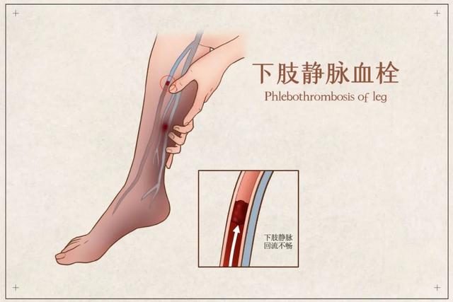 塑心学堂 | 下肢水肿因素多，及时就医早诊断