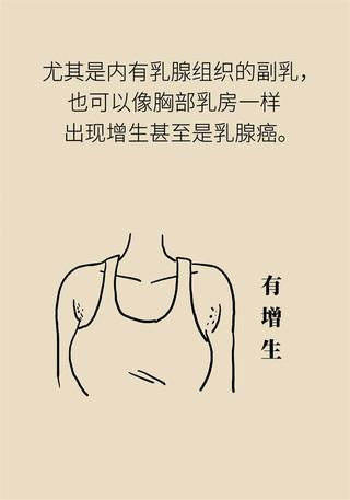 副乳也会得乳腺癌？关于它你了解多少