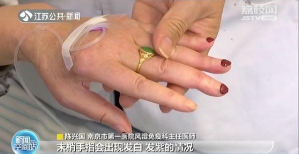 南京女子冬天手指发冷变白 竟是患了免疫疾病“雷诺综合征”