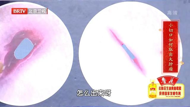 乳房上长肿瘤，10天长到20斤！自查方法，女生一定要掌握