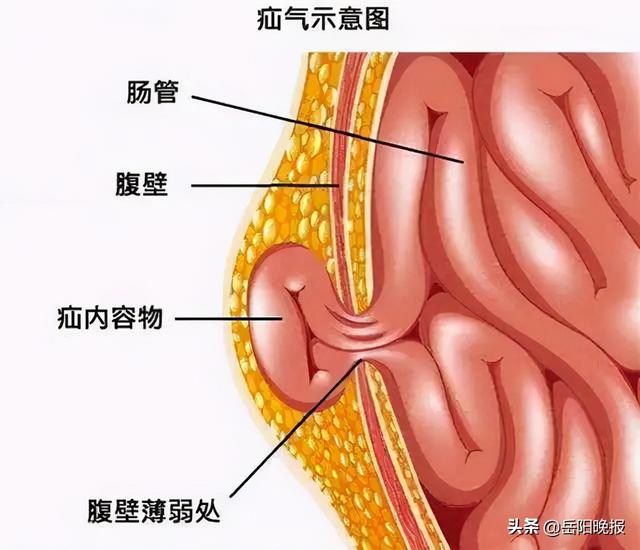 岳阳市中医医院：用专业和专注破解治疝“拦路虎”