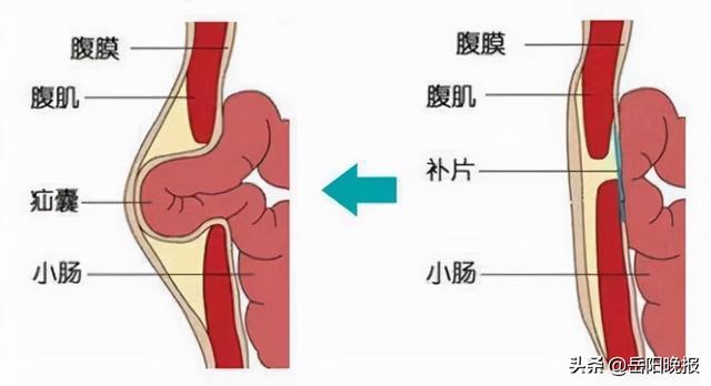 岳阳市中医医院：用专业和专注破解治疝“拦路虎”