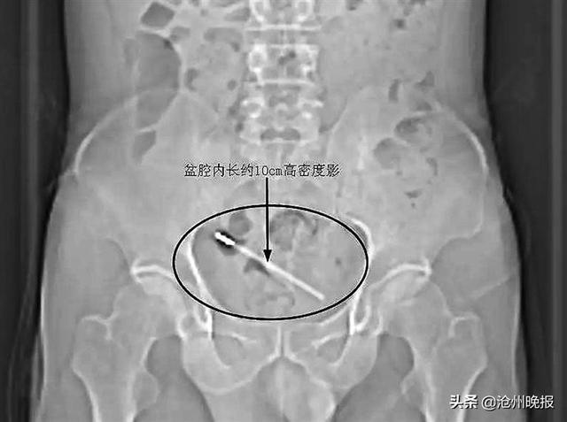 献县一名男子竟将体温计在尿道内“藏”了10年