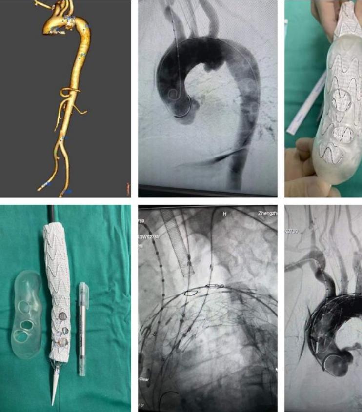 【医疗技术】“3D打印”技术助力治疗高难度主动脉瘤